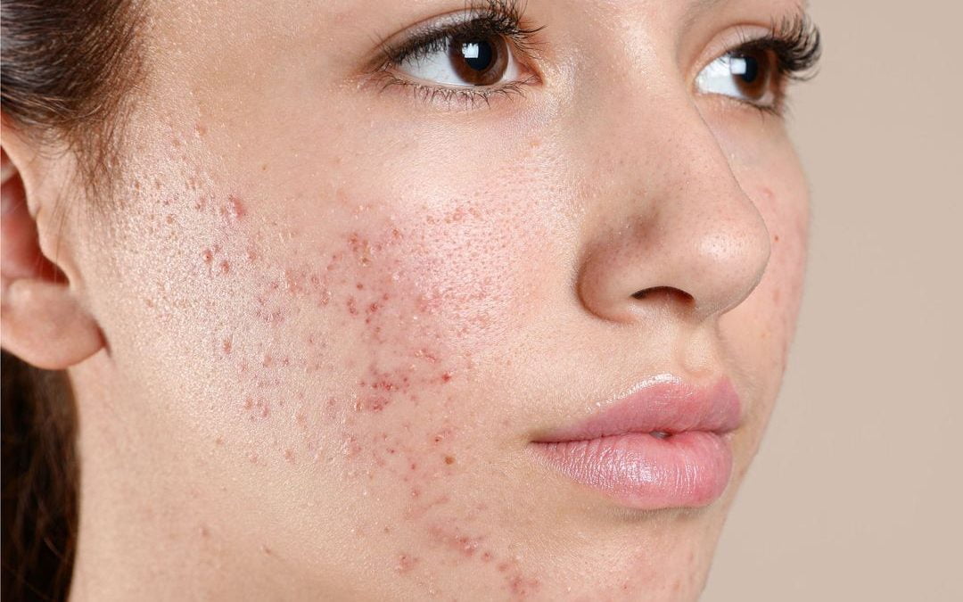 Laser Acne Treatment